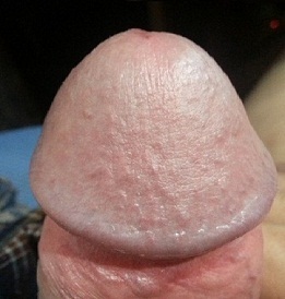 Foto del glande agrandado del pene