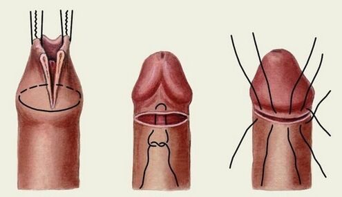 la esencia de la cirugía de alargamiento del pene