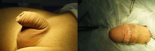 pene antes y después de la cirugía de agrandamiento