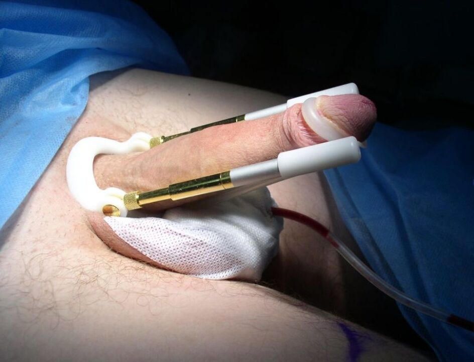 extensor después de la cirugía de agrandamiento del pene