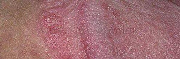 Piel seca y úlceras en la cabeza del pene después de usar bicarbonato de sodio