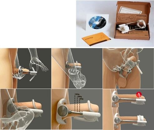 Agrandamiento del pene usando un extensor