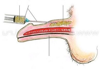 agrandamiento del pene por inyección