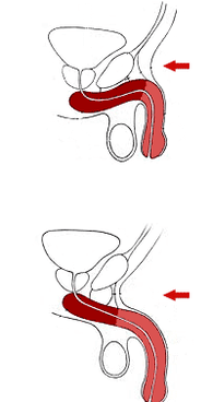 antes y después de la cirugía de agrandamiento del pene