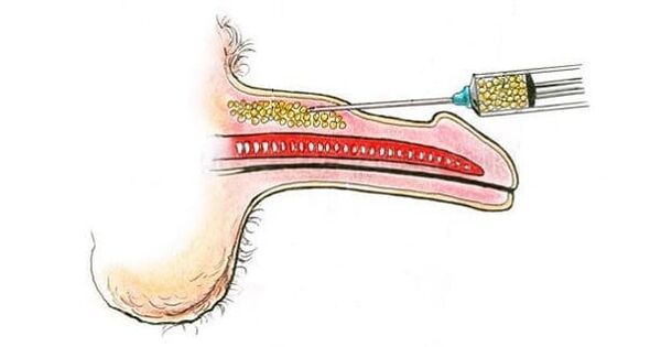 Trasplante de tejido muscular para agrandar el pene.