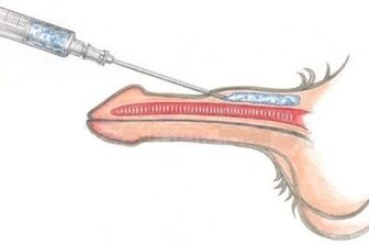 Un método peligroso para agrandar el pene mediante inyecciones de vaselina.
