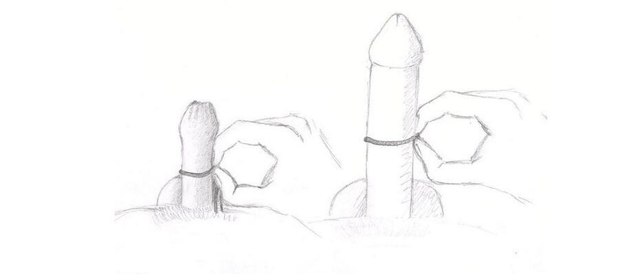 medición del espesor del pene